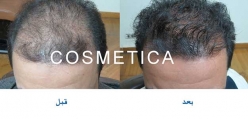 FUE Hair Transplant