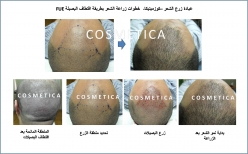 FUE HAIR TRANSPLANT STEPS