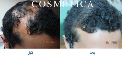 FUE Hair Transplant  for scars