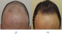 زراعة الشعر بالاقتطاف FUE