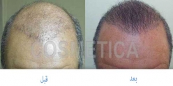 FUE Hair Transplant after biofiber removal