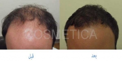 زراعة الشعر بالاقتطاف FUE