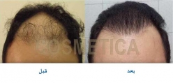 FUE hair transplant 