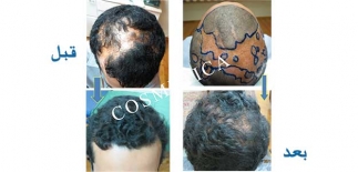 FUE Hair Transplant  for scars