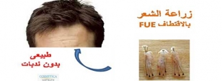 زراعة الشعر بالاقتطاف FUE