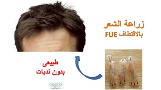 FUE HAIR TRANSPLANT