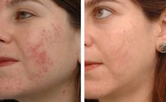 Acne vulgaris