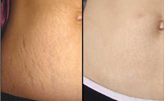 Stretch marks or striae