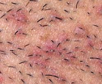 Ingrown hair