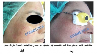 Melasma