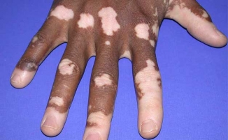 Vitiligo 