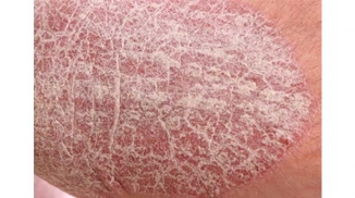 Psoriasis