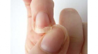 MANAGEMENT of NAIL DISEASE